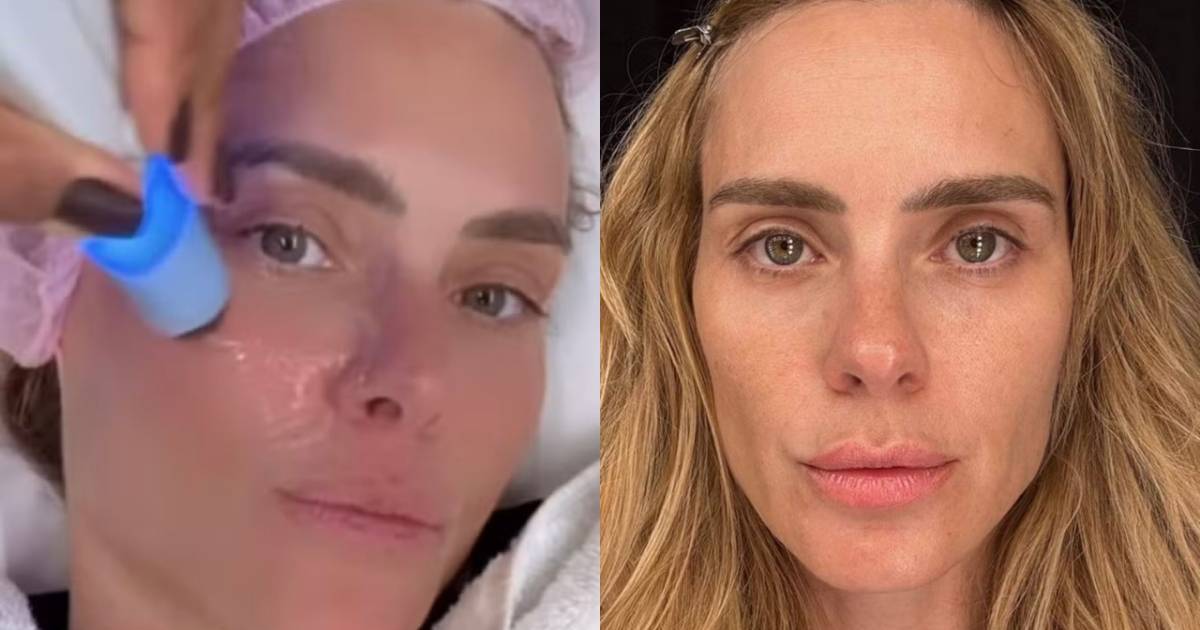 Tratamento facial não invasivo: entenda o procedimento estético adotado por Carolina Dieckmann